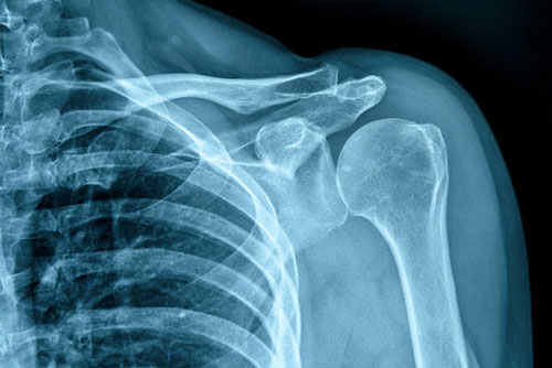 Röntgenaufnahme der Schulter